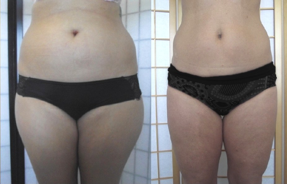 UltraSlim-before-after Citrus Mist Spray