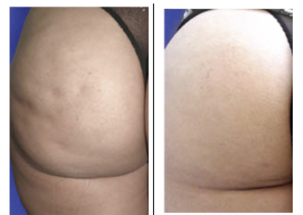 cellulite-buns (1) Citrus Mist Spray